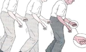 Parkinson Hastalığı ve Tedavisi Güncel Bilgiler