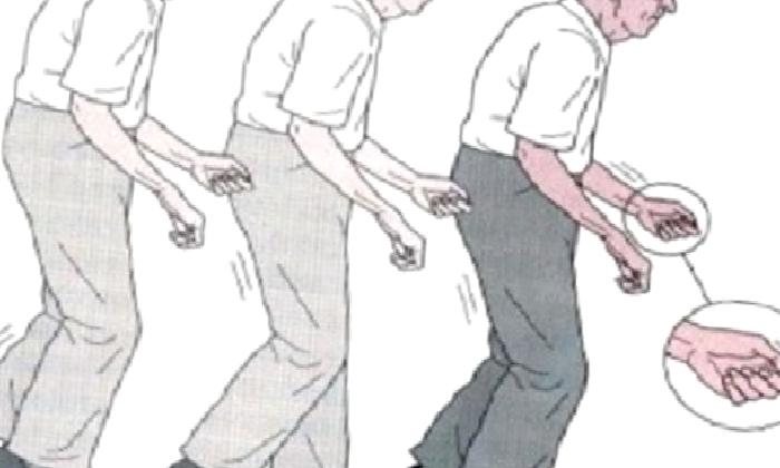 Parkinson Hastalığı ve Tedavisi Güncel Bilgiler