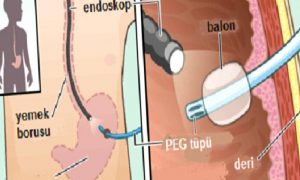 PEG (Perkutan Endoskopik Gastrostomi)