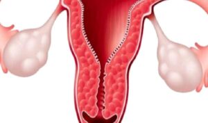 Pelvik Enfeksiyonlar