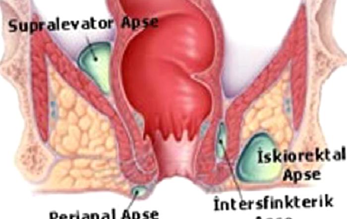 Perianal Apse
