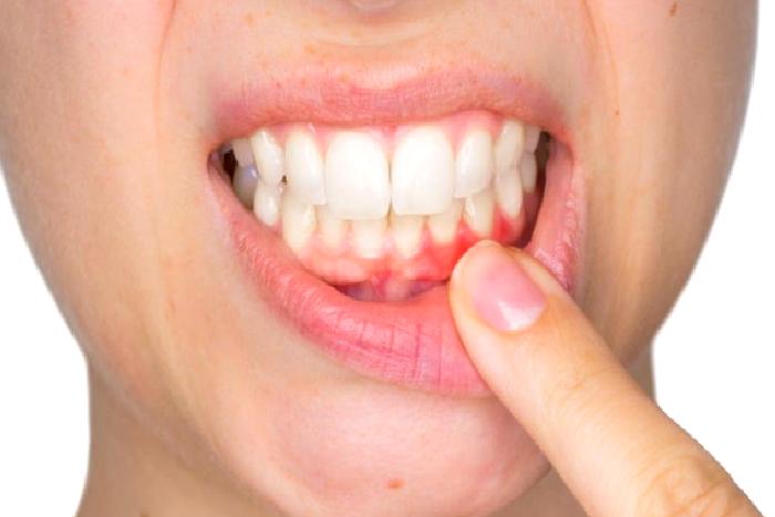 Periodontoloji (Dişeti Hastalıkları ve Tedavisi)