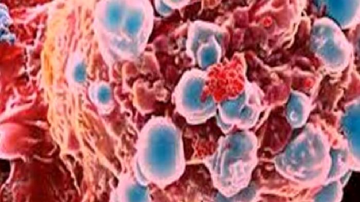 Peritoneal Karsinomatoz – Karın Zarı Kanseri – Karın Zarına Metastaz
