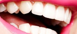 Porcelain Laminate Veneers