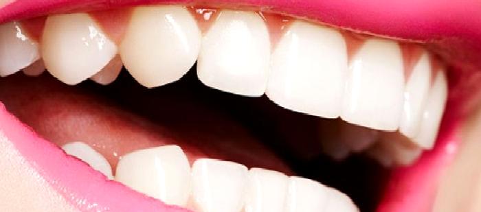 Porcelain Laminate Veneers