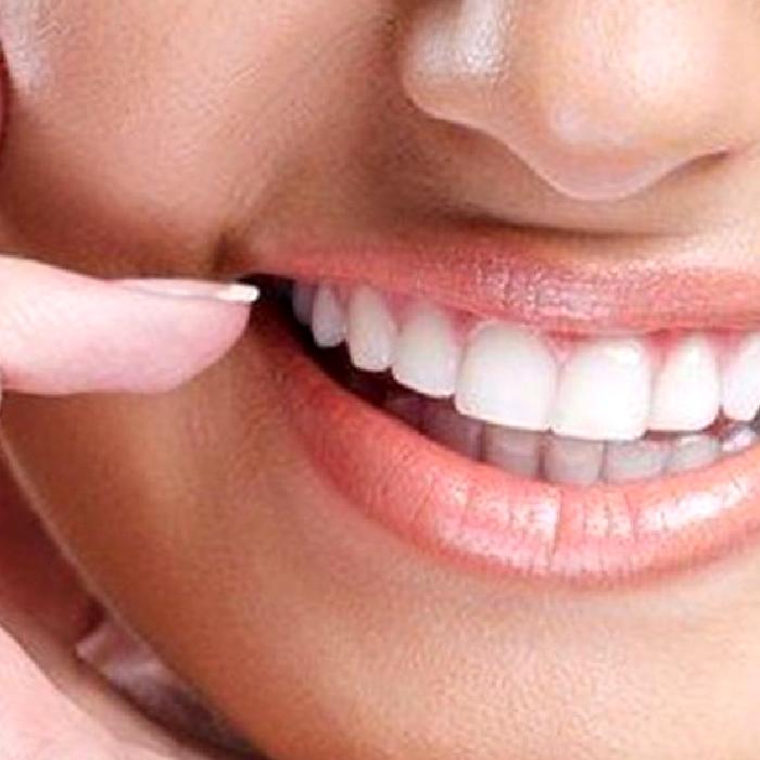 Porselen Lamina (Laminate Veneer)