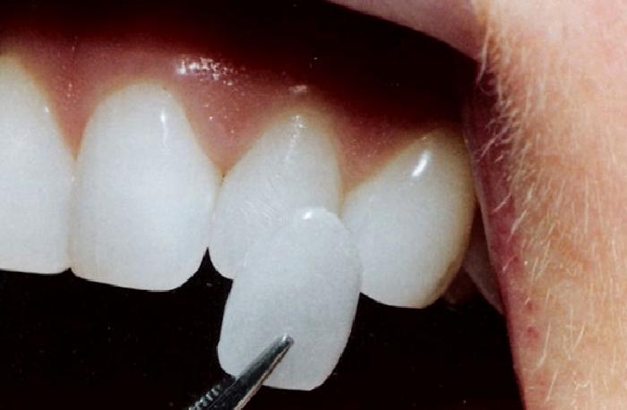 Porselen Laminate Veneerler