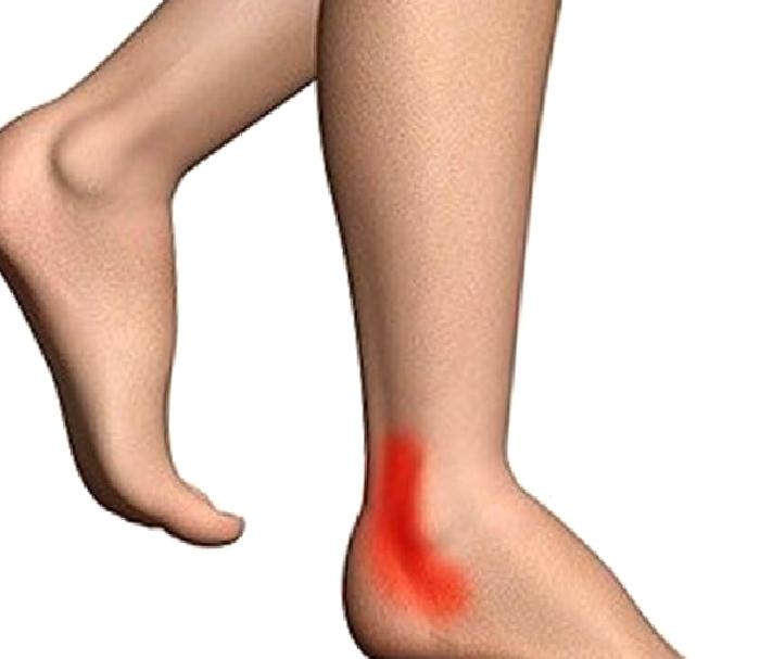 Posterior Tibial Tendon Disfonksiyonu