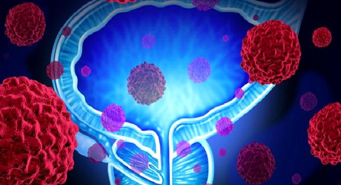 Prostat Kanseri Tedavisinde Yenilikler