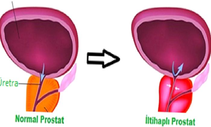 PROSTATİT