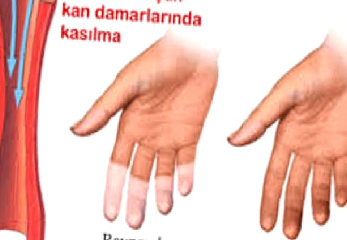 RAYNAUD HASTALIĞI