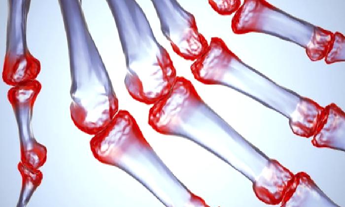 ROMATOİD ARTRİT