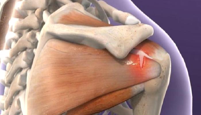 Rotator Manşet Yırtığı