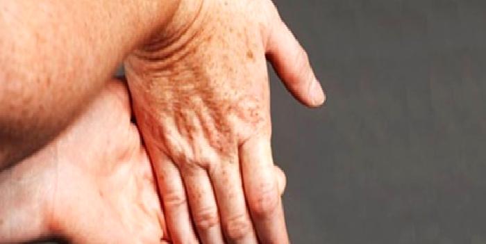 Saat ve Yüzüğünüz Aşırı Sıkmaya Başladıysa…