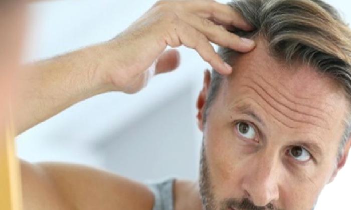 Saç Dökülmesi (Alopesi)