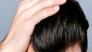 Saç Dökülmesinin Nedeni Nedir?
