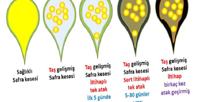 Safra Kesesi Taşı
