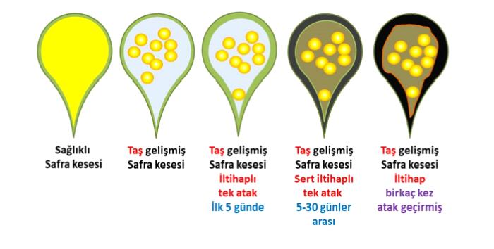 Safra Kesesi Taşı