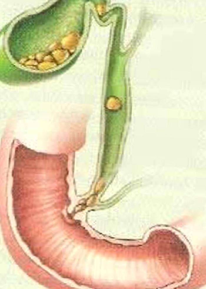 Safra Kesesi Taşları