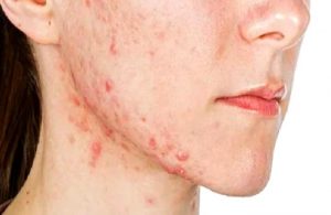 Saman nezlesi (Alerjik rinit), Astım ve Atopik dermatit (Alerjik egzema) gibi alerjik hastalıkların Akupunktur ile Tedavisi