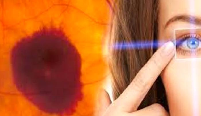 Sarı Nokta Hastalığı (Yaşa Bağlı Makula Dejenerasyonu) Nedir?