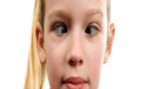 Şaşılık Hakkında Bilinmesi Gerekenler: