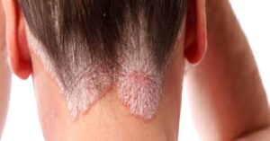 Sedef Hastalığı Nedir ?