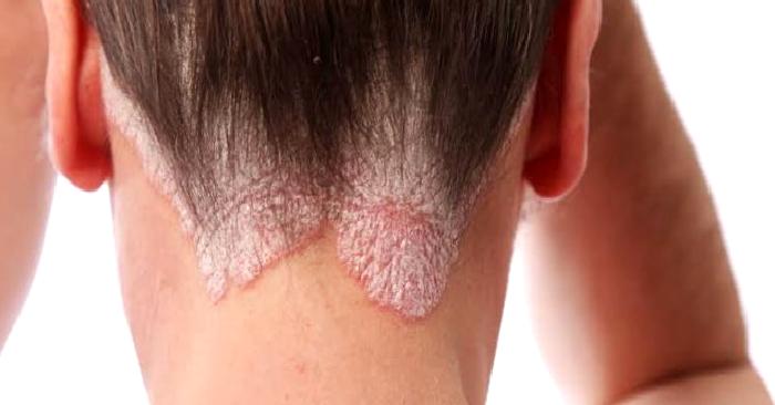 Sedef Hastalığı (Psoriasis)