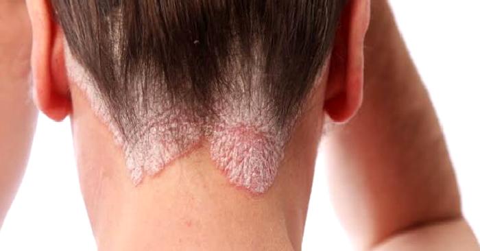 Sedef Romatizmasına Dikkat!