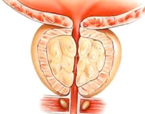 Selim Prostat Büyümesi (Benign Prostat Hiperplazisi-BPH)