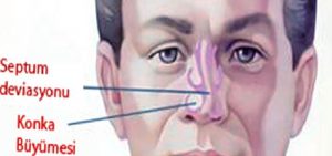 Septum Deviasyonu (Burun Orta Kemik Eğriliği)
