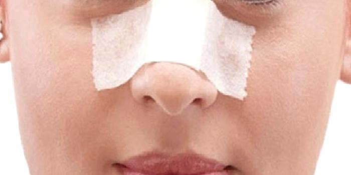 SEPTUM PERFORASYONU ( BURUN DUVARINDA DELİK )