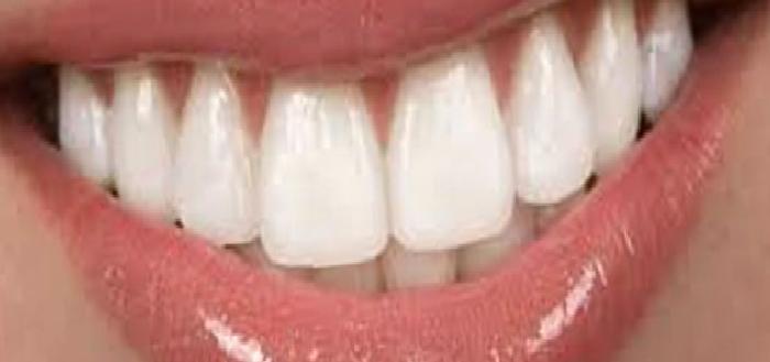 Seramik Laminate Veneerler