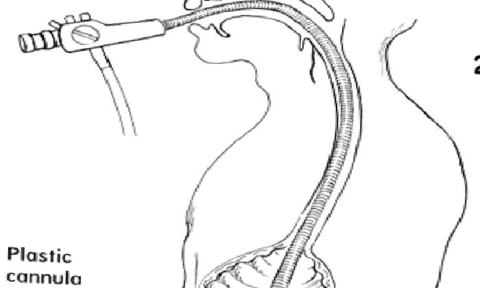 SEREBRAL PALSİ HASTALARININ BESLENMESİNDE GASTROSTOMİ TÜPÜ UYGULANIMI