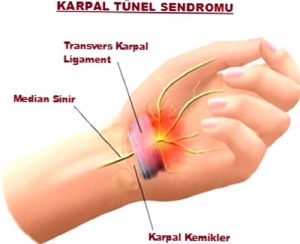 SİNİR SIKIŞMASI(TUZAK NÖROPATİLERİ)