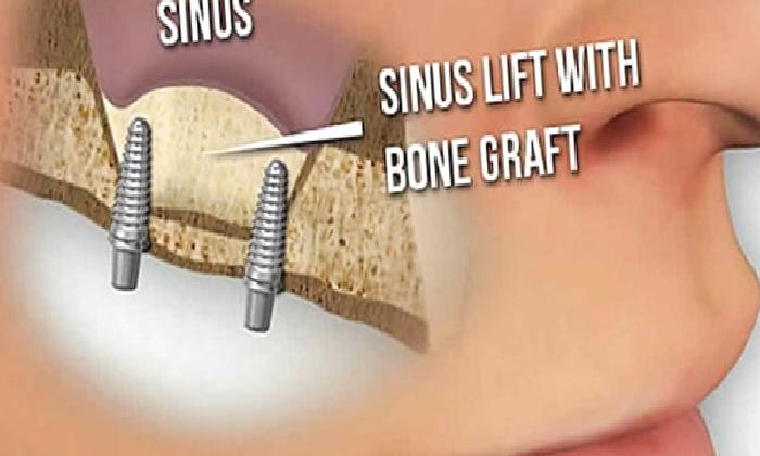 SİNÜS LİFTİNG İŞLEMİ