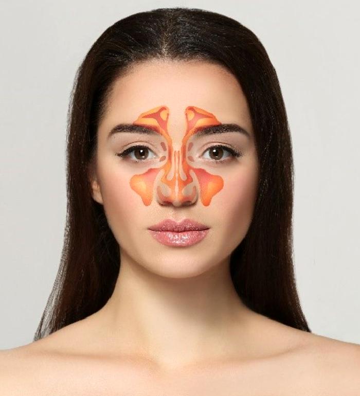 Sinüzit Problemi Nedir?