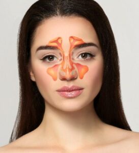 Sinüzit ve Baş Ağrısı