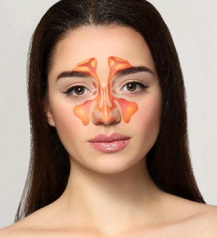 Sinüzit ve Baş Ağrısı