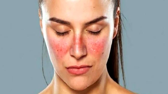 Sistemik Lupus Eritematozus Nedir?