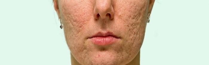 Sivilce (Akne) ve Sivilce İzlerinin Tedavisi