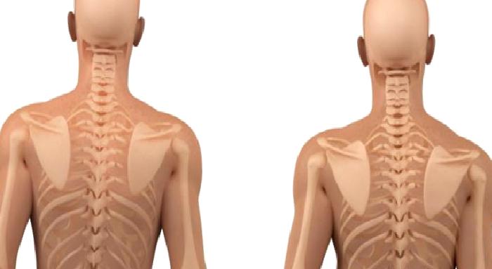 Skolyoz Hangi Sıklıkla Görülür?