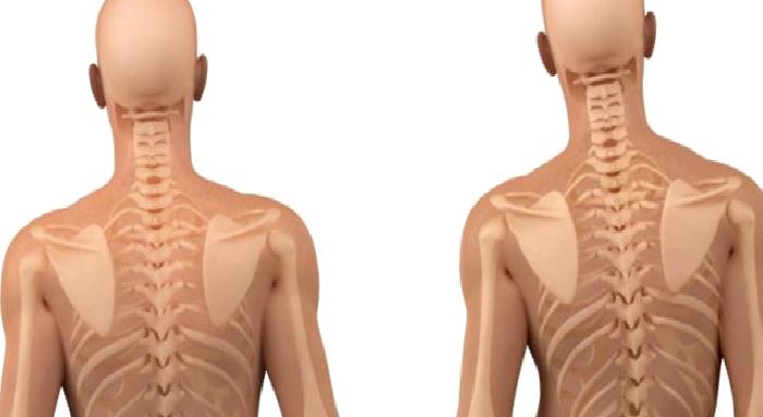 Skolyoz Nedir?
