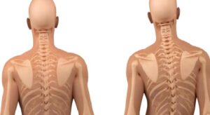 Skolyoz Nedir?