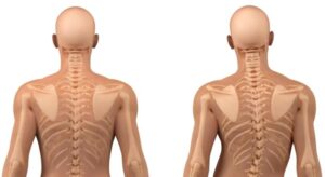 Skolyoz Tedavisi Nasıl Olmalıdır?