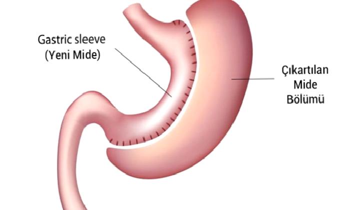 Sleeve Gastrektomi (Tüp Mide Ameliyatı)