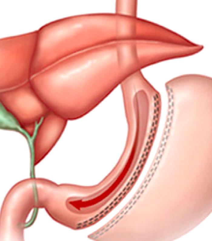 Sleeve Gastrektomi (Tüp Mide) Ameliyatı