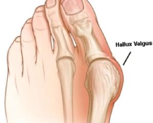 Soruda Hallux Valgus (Başparmak Kemik Çıkıntısı)