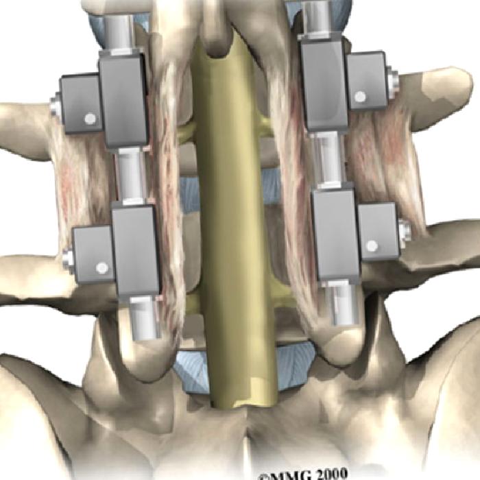 Spinal Füzyon