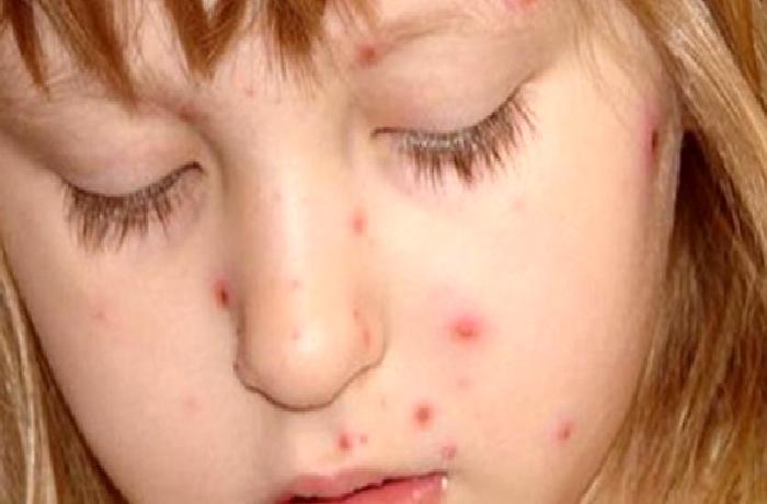 Su Diyeti Nasıl Yapılır, Zararları Nelerdir?